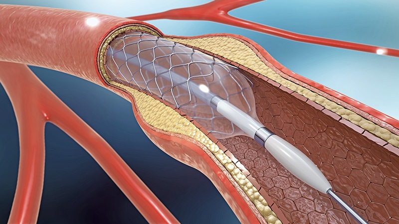 Percutaneous Coronary Intervention